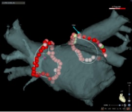 3次元マップを用いた心房細動に対する高周波カテーテルアブレーション